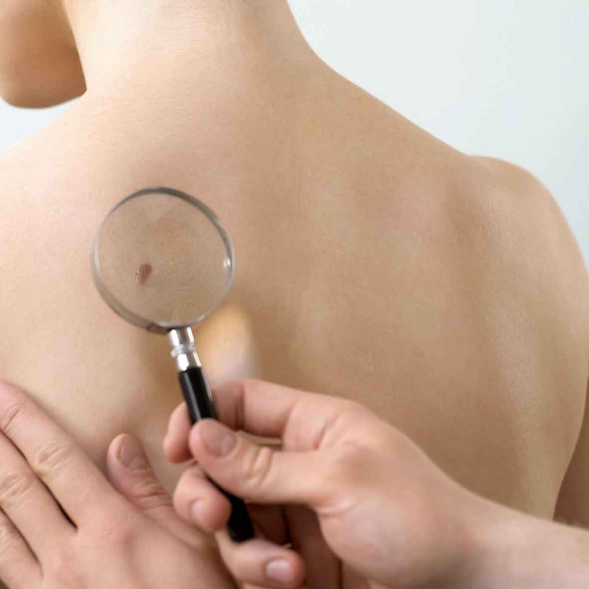 Nốt Ruồi Ở Lưng_ Điềm Báo Giàu Sang Hay Cuộc Đời Vất Vả