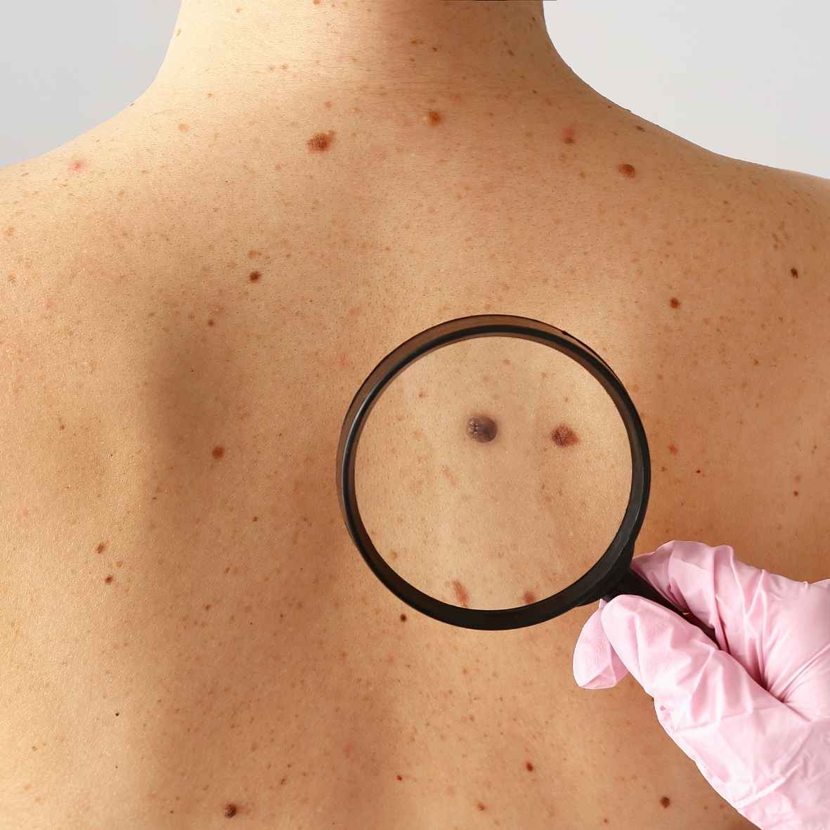Nốt Ruồi Ở Lưng_ Điềm Báo Giàu Sang Hay Cuộc Đời Vất Vả